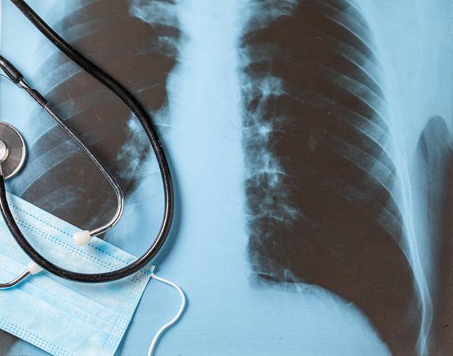 open day pneumologico vivisol medicalsangallo x-ray coronavirus long covid