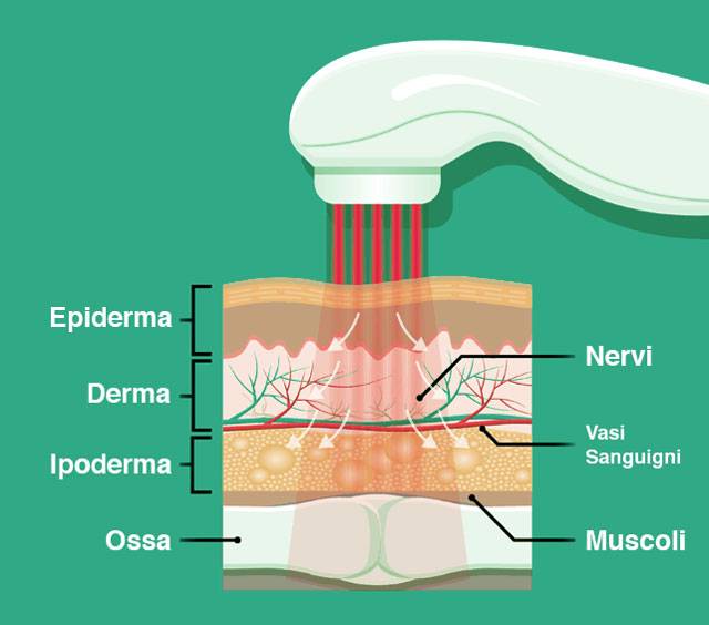 effetti della laser terapia sui tessuti umani